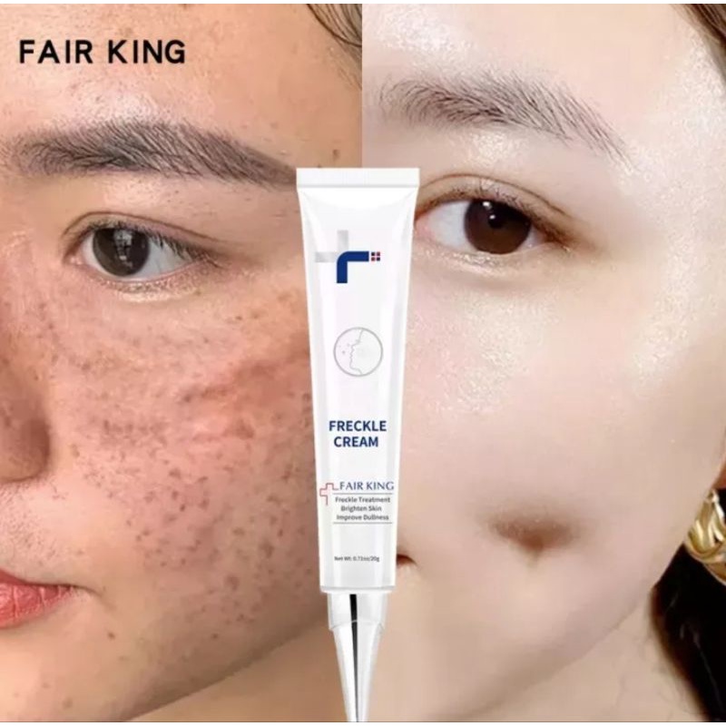 FAIR KING EFFECTIVE FRECKLE CREAM REMOVE DARK SPOT WHITENING CREAM FADE ACNE MELASMA-ANTI AGING SKIN LIGHTENING- CREAM PEMUTIH-KRIM PEMUTIH-WAJAH GLOWING KRIM-CREAM PENGHILANG FLEK-WAJAH CREAM SIANG MALAM-CREAM WAJAH GLOWING-20ml