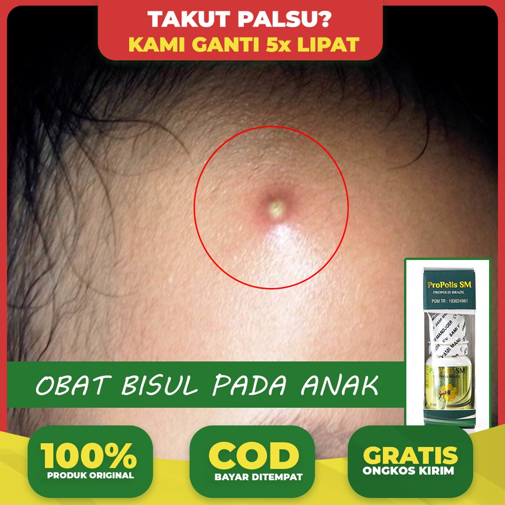 Obat Bisul Anak, Bisul Bernanah, Sakit, Bisul di Ketiak, Pantat, Seluruh Badan - Propolis Sm 100% As