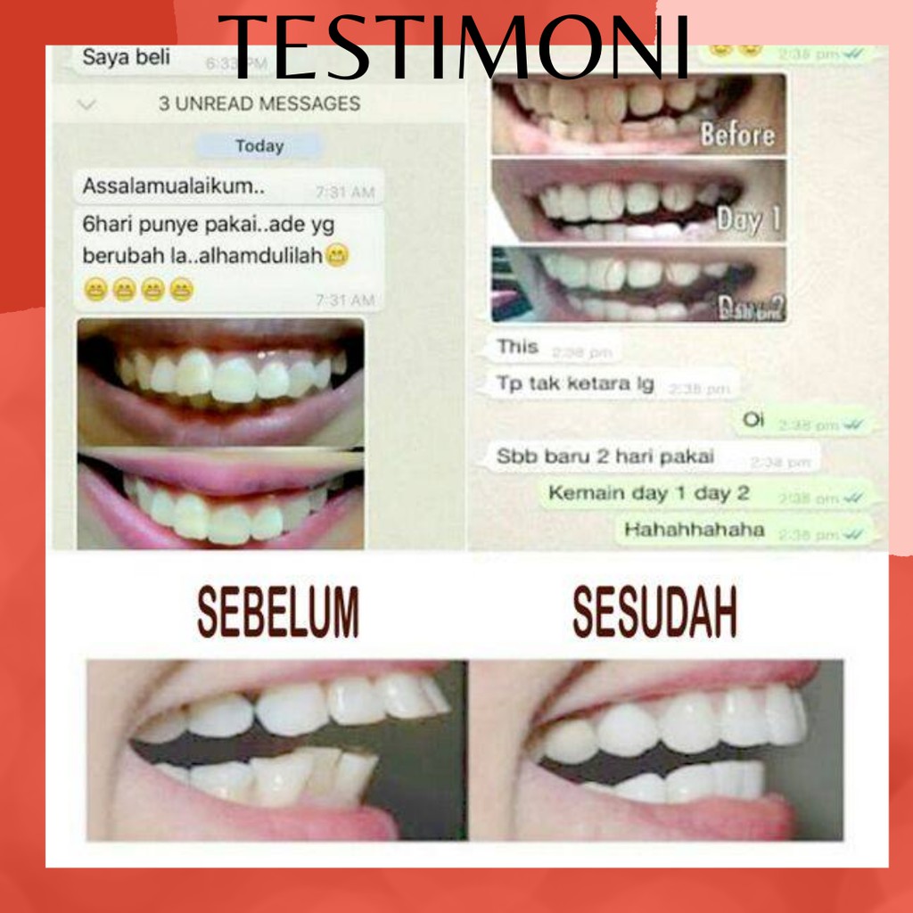 Behel Lepas Pasang Alat Perapi Gigi Retainer Perapih Gigi Tanpa Kawat Behel Teeth Trainer Alignment Perapih Gigi Anak Dan Dewasa Original