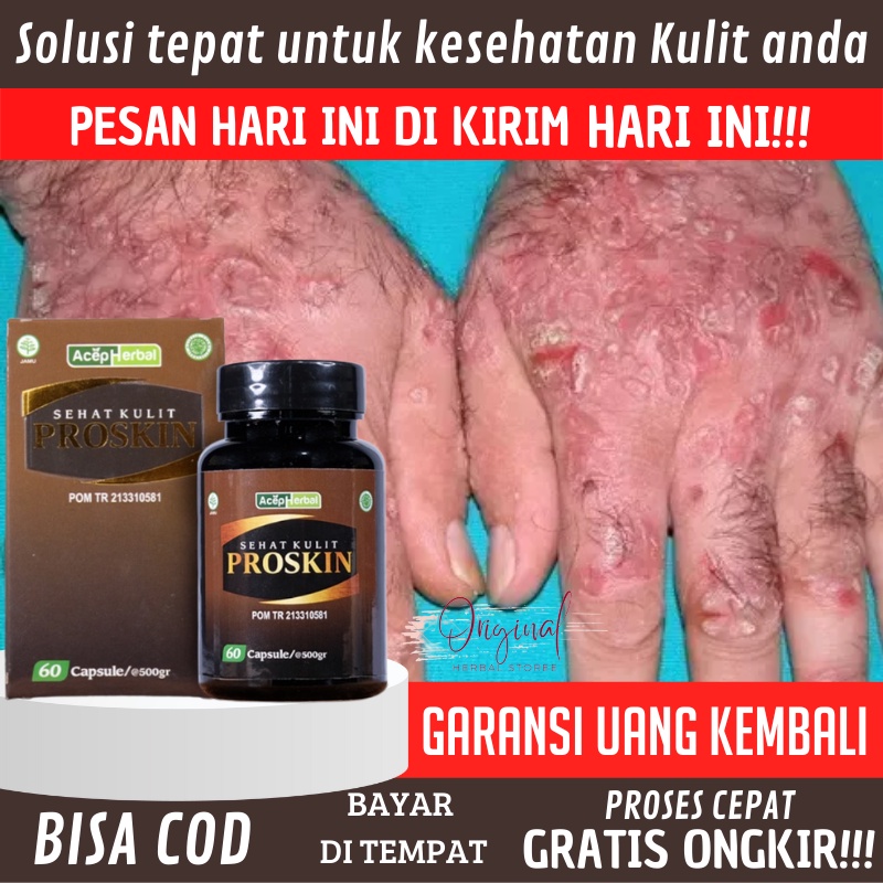 Obat Eksim anak / dewasa, Salep scabies, Obat Gatal Eksim, Salep eksim kering Menahun, Obat eksim ke