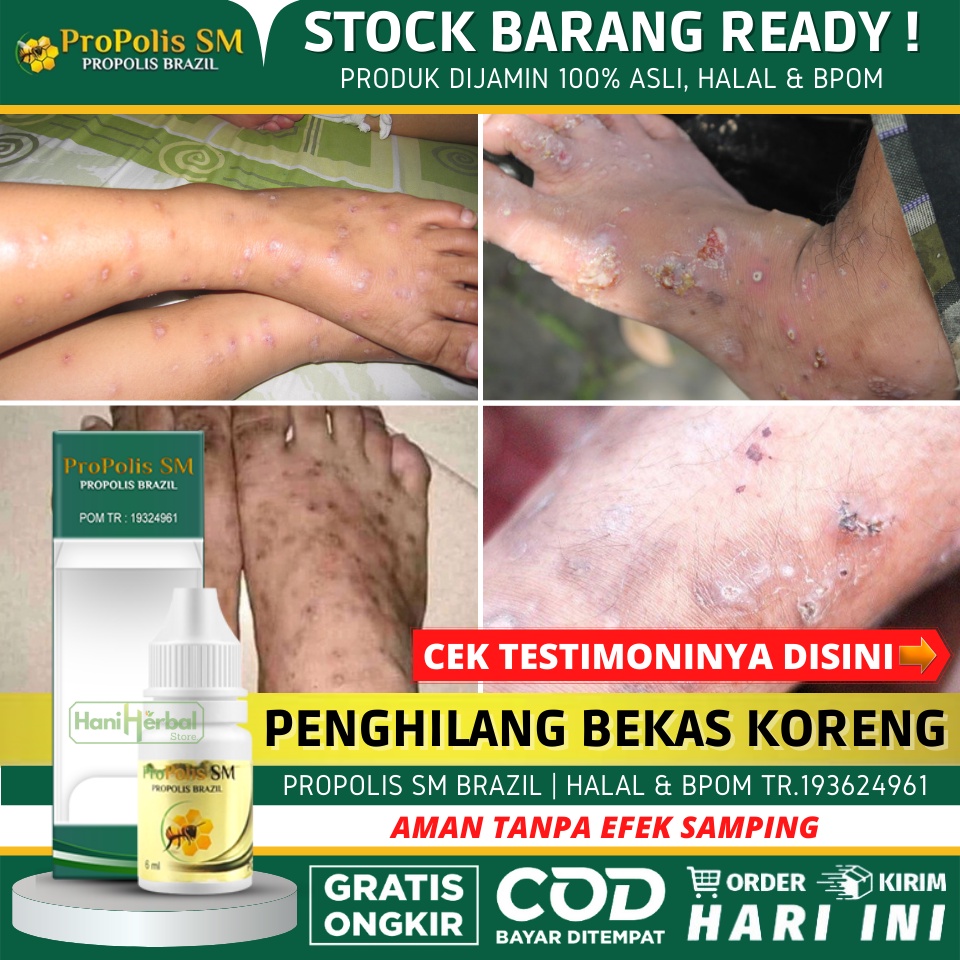 Obat Penghilang Bekas Koreng 100% Alami, Obat Koreng Bernanah, Obat Koreng di Kaki, Koreng di Kepala