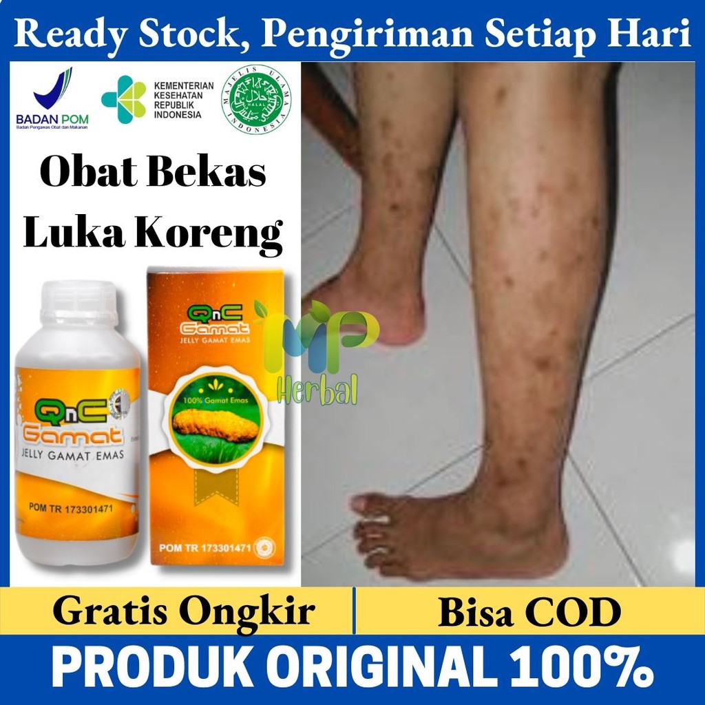 Jual Obat Luka Bekas Koreng Obat Herbal Luka Koreng Obat Penghilang Koreng Di Kaki Qnc Jelly