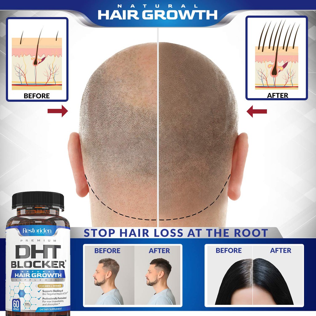 Hair loss treatment jakarta