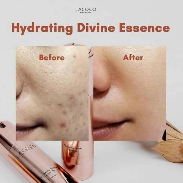 LACOCO HDE asli nasa meratakan wajah bopeng