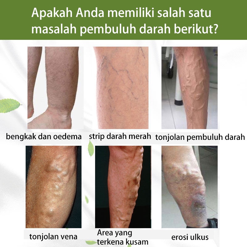 obat varises 50g Varises Obat Varises Paling Ampuh Pijat kaki untuk menghilangkan rasa sakit / mengeruk meridian / perawatan relaksasi vena dan krim perbaikan Bengkak Benjolan Vaskulitis Flebitis Pengobatan Vaskulitis