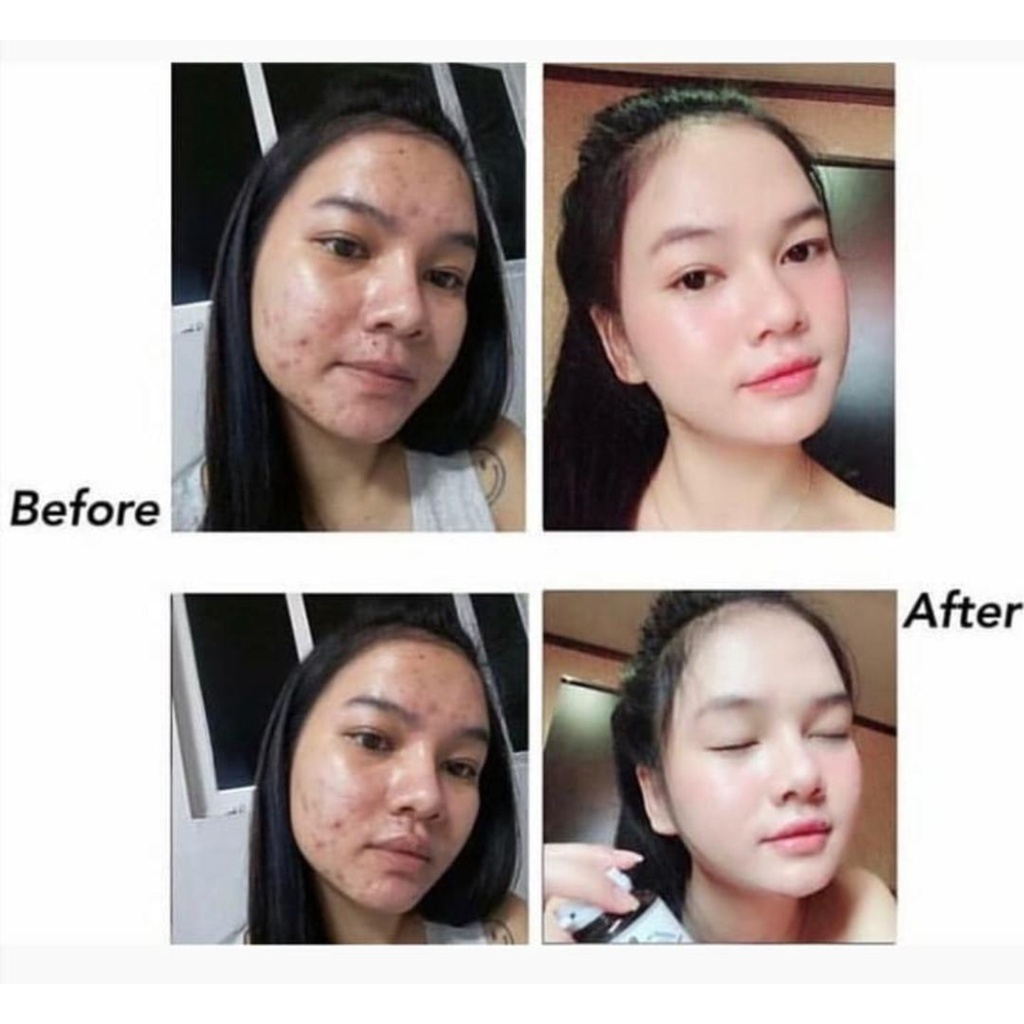 Cream Obat Jerawat Paling Ampuh ​Acne Rejuvenation Cream Jerawat Krim Jerawat Menghilangkan Jerawat Cepat Menghilangkan Jerawat Removal of Acne Cream Untuk Memperbaiki Kulit Denga Krim Penghilang Jerawat dan Bekas Jerawat Pria dan Wanita 30g