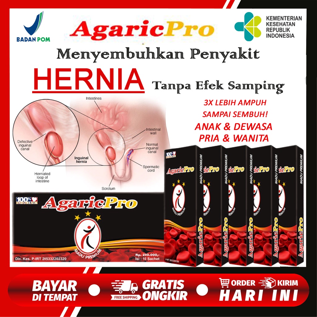 

Obat Hernia Paling Ampuh Tanpa Operasi - Obat Hernia Anak Tanpa Operasi - Obat Hernia Anak Laki Laki, Obat Herbal Hernia Anak, Obat Hernia Bayi Balita, Orok, Obat Hernia Inguinalis, Umbilical, Hiatal, Epigastric AGARICPRO