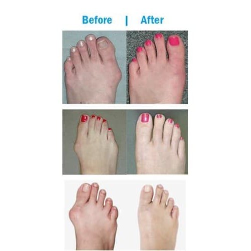 ALAT PENYANGGA TULANG KAKI ELASTIC BUNION CORRECTOR