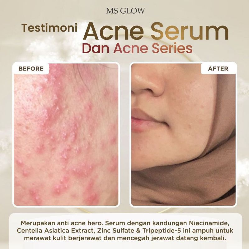 Paket Acne + Red Jelly Lactobacillus || MS GLOW