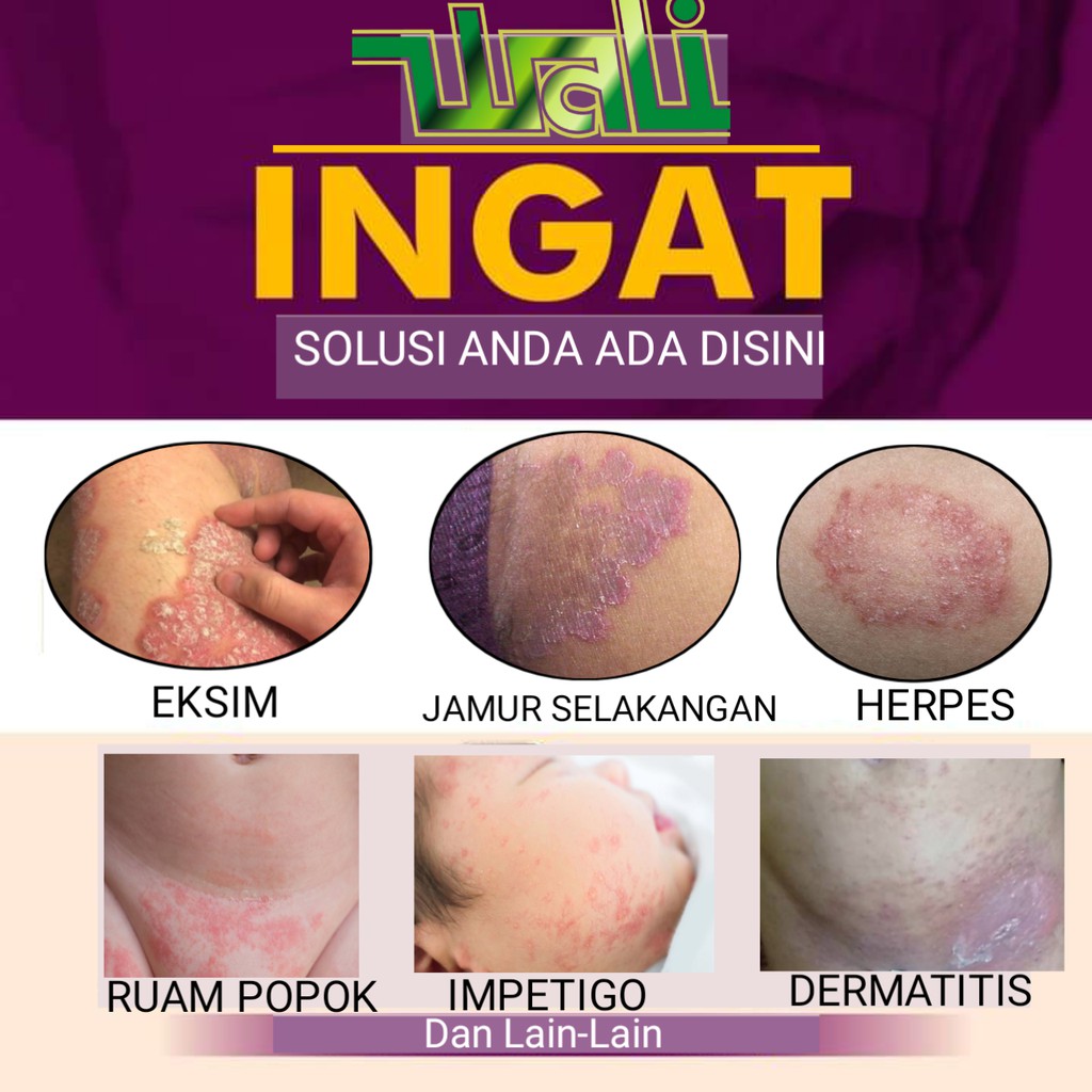 Salep gatal eksim salep gatel kulit obat gatal menahun dermatitis kaligata-1
