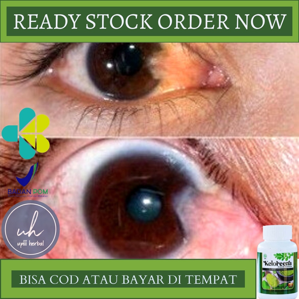 Obat Mata Pterigium, Obat Untuk Mata  Pterigium, Obat Penyakit Mata Berlemak, Obat Mata Berlemak, Ob