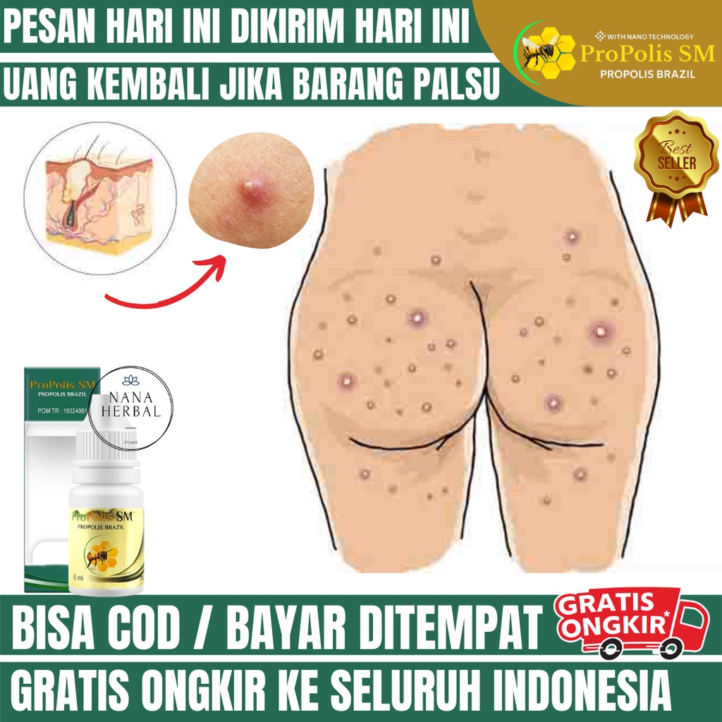 Obat Jerawat Bokong, Obat Pantat Burik, Obat Pantat Hitam, Obat Pantat Gatal, Obat Bruntusan Pantat,