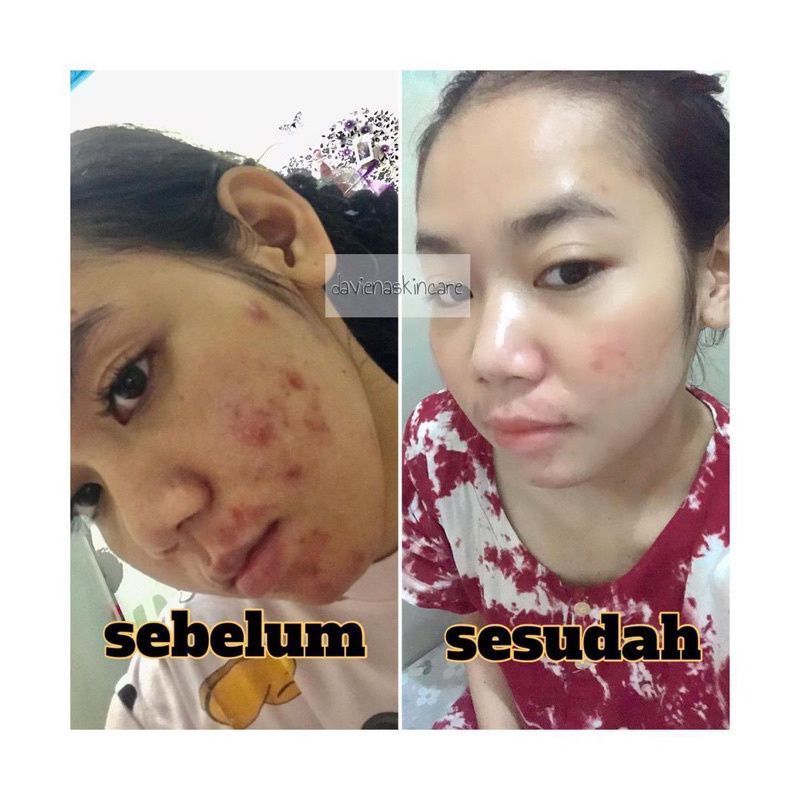 Paket Hemat Acne 2 Daviena Skincare Davienaskincareofficial Davina Devina Lampung Surabaya Jakarta Jerawat Pencerah Pemutih Wajah Glowing Bpom Daviena Skincare