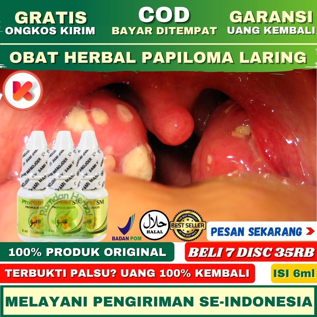 Obat Papiloma Laring Tumor Jinak Obat Herbal Papiloma PROPOLIS SM 100% ORIGINAL