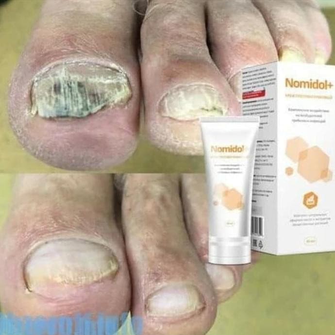 Cream Nomidol + Obat Jamur Kuku Aman Original