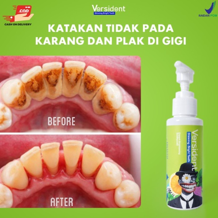 VERSIDENT Shinning Bright Teeth Original BPOM - Pemutih gigi, Pembersih Karang gigi, Mengatasi Bau Mulut