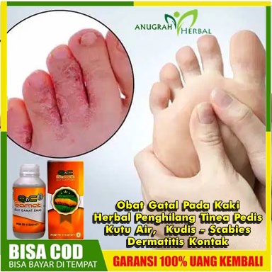 Obat Gatal Pada Kaki  Herbal Penghilang Tinea Pedis - Kutu Air,  Kudis - Scabies, Dermatitis Kontak