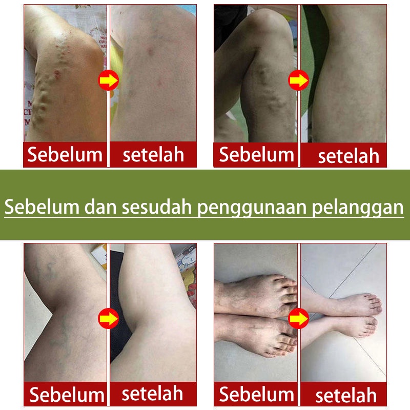 obat varises 50g Varises Obat Varises Paling Ampuh Pijat kaki untuk menghilangkan rasa sakit / mengeruk meridian / perawatan relaksasi vena dan krim perbaikan Bengkak Benjolan Vaskulitis Flebitis Pengobatan Vaskulitis