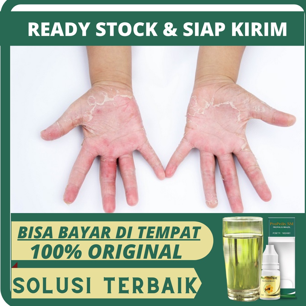 Obat Dermatitis, Obat Dermatitis Kontak, Obat Dermatitis Seboroik, Obat Dermatitis Perioral, Obat De