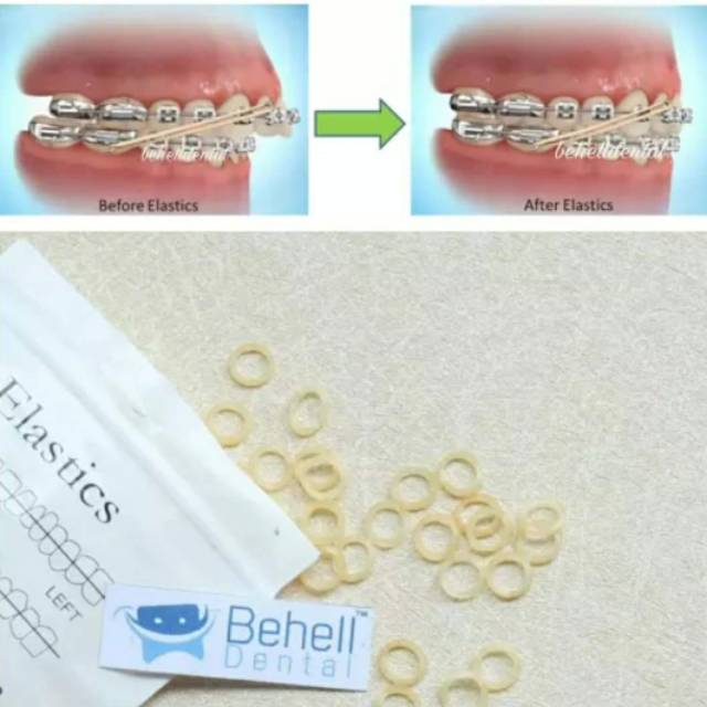 100 pics Karet Behel Elastis // Elastic Band ortho // Rubber Dental Kawat Gigi Penutup Gigi Renggang Penarik Gigi Original // oz 3.5 5.0 6.5 ukuran 1/8 1/4 3/8 3/16 5/16 // Orthodontics Orthodontic Behelldental // 1 pack isi 100 bulatan