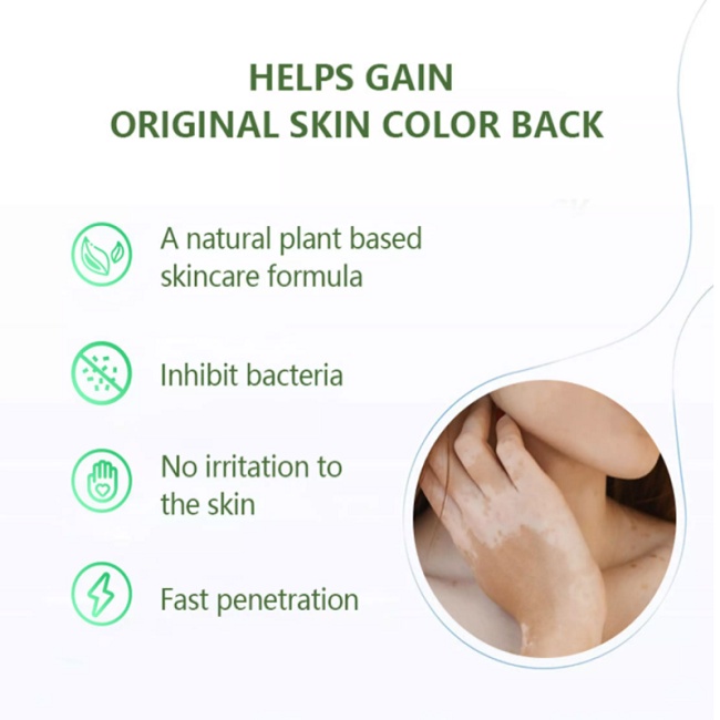 Cream Penghilang Vitiligo Salep Vitiligo Bintik Putih