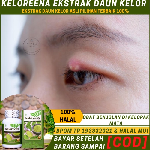 Obat Benjolan Di Mata, Menghilanngkan Benjolan Di Mata, Obat Kalazion Alami, Penghilang Kalazion Mat