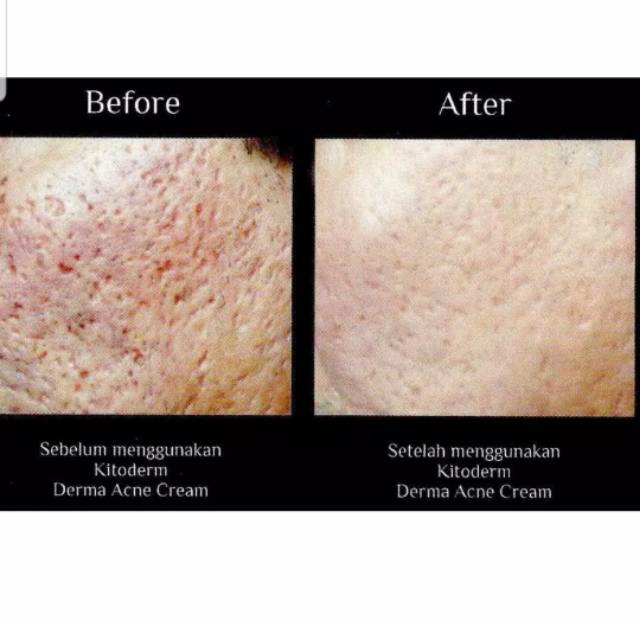 KITODERM DERMA ACNE CREAM