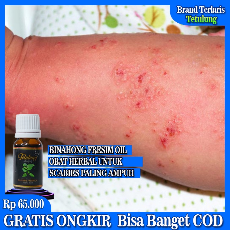 Fresim Oil, Obat Scabies, Obat Scabies Manusia Paling Ampuh, Obat Gatal Scabies, Obat Ampuh Untuk Pe