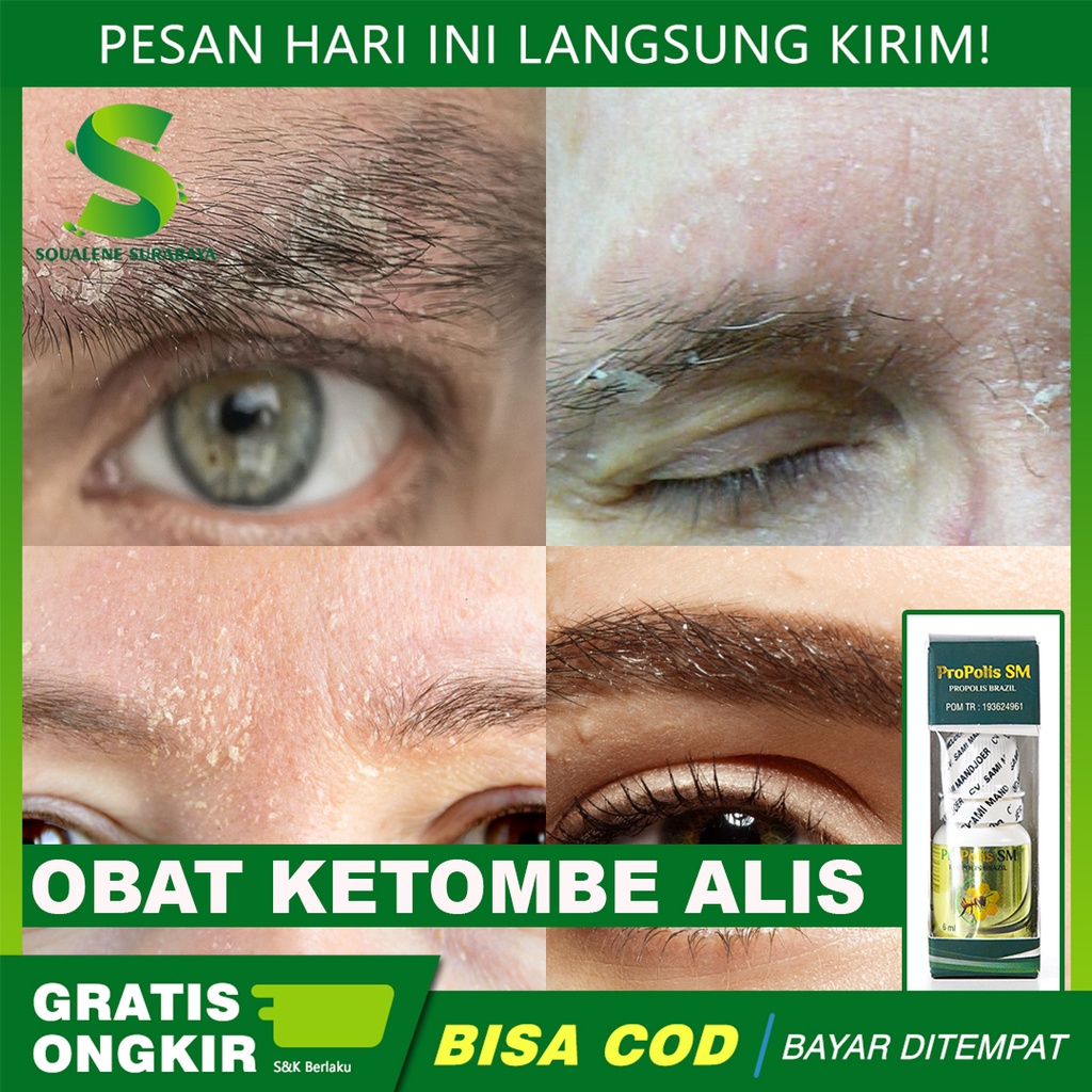 Jual Obat Ketombe Alis Pembersih Ketombe Ketombe di Kepala