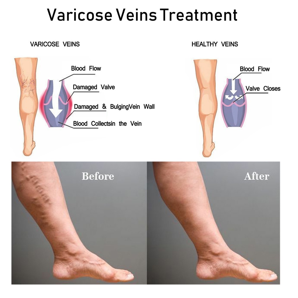 Obat Varises Salep Varises Cream Varicose Veins Varikokel Bengkak Benjolan Buah Zakar Nyeri Testis Vaskulitis Flebitis Pengobatan Vaskulitis Salep