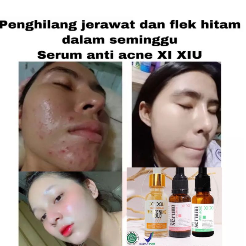 serum wajah xi xiu vit c/acne/gold bpom xixiu termurah/essense pelicin kulit muka penghilang komedo 