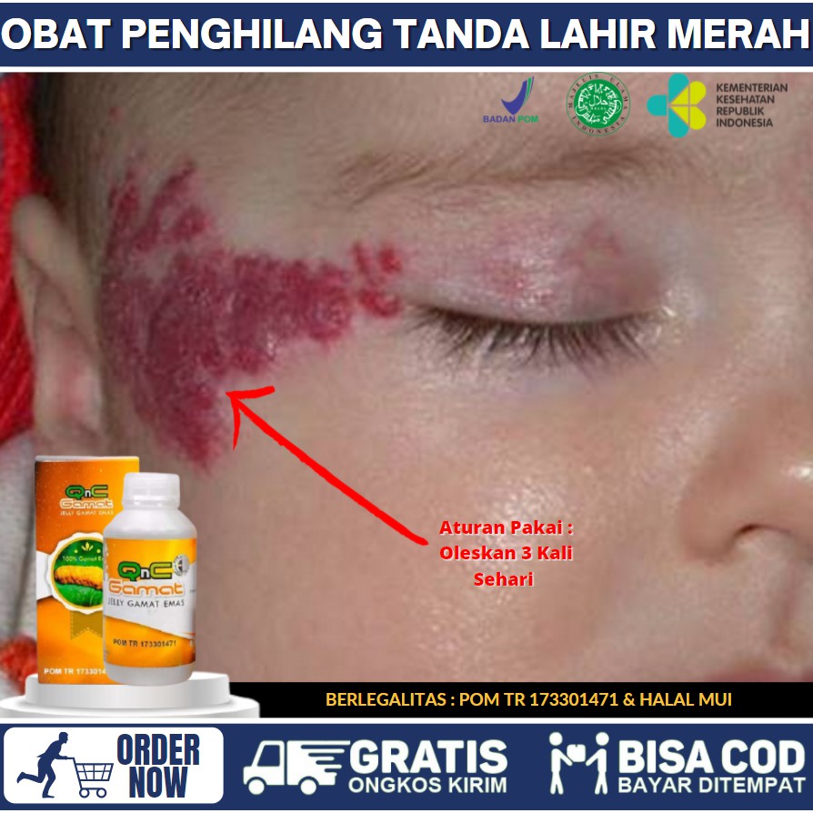 Obat Hemangioma Anak & Dewasa, Penghilang Tanda Lahir, Herbal Hemangioma Pada Bayi, QnC Jelly Gamat