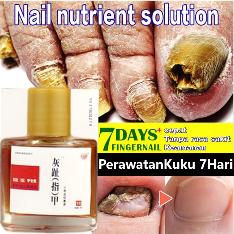 Perawatan Jamur Kuku Paronychia Perawatan Lumut Kuku Pemutih Kuku Penghilang Jamur Kuku Gel Anti Infeksi 150g