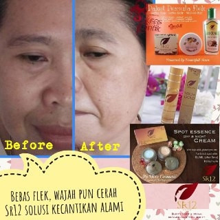 SPOT ESSENCE DAY &amp; NIGHT CREAM SR12 | TUMPAS BEKAS JERAWAT | FLEK HITAM &amp; NODA WAJAH | STANDAR BPOM