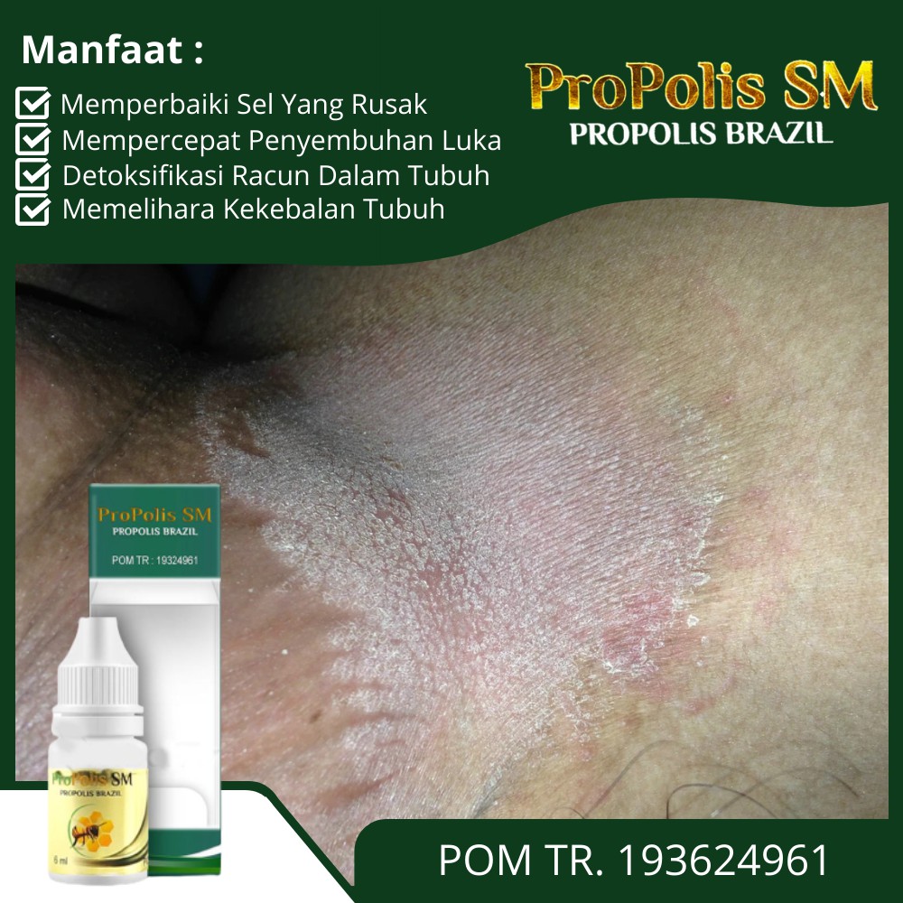 Obat Kulit Gatal Selangkangan Kulit Gatal Diselangkangan Menghitam Kering Propolis Sm Shopee Indonesia