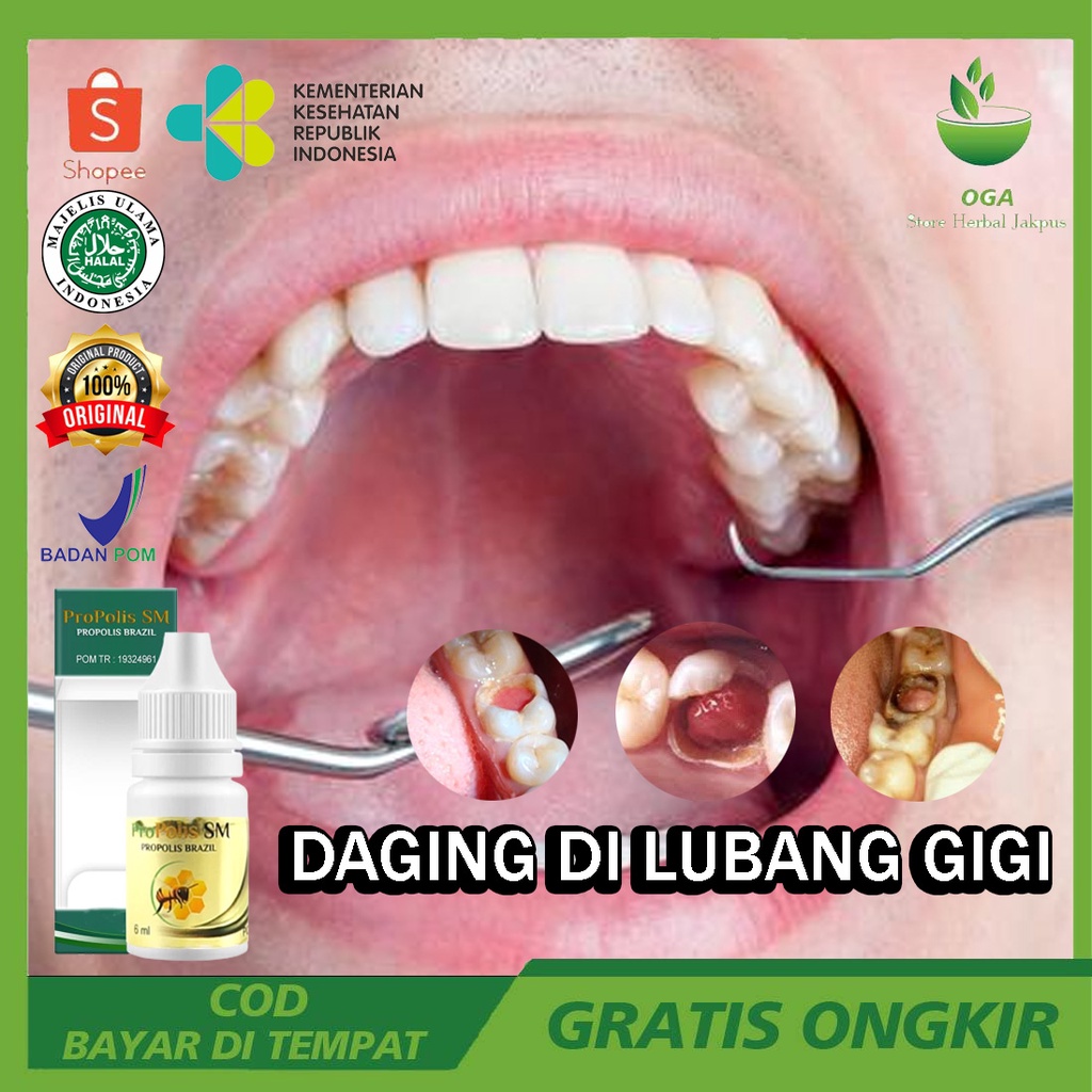 Obat Penghancur Daging Di Lubang Gigi, Daging Tumbuh Di Lubang Gigi, Gusi Tumbuh Di Lubang Gigi, Pen