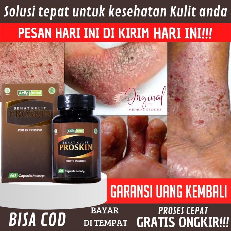 Obat eksim, Obat Scabies Manusia, Salep eksim kering Menahun, Obat eksim kering, Salep exim, Obat ga
