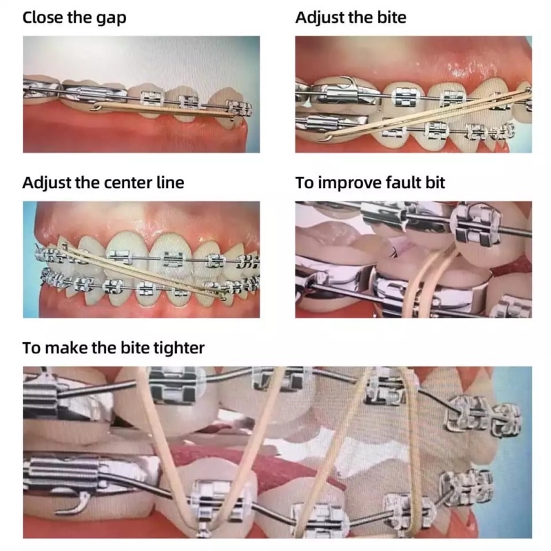 Karet elastik gigi ortho behel dental rubber band elastis karet elastic oz kawat gigi renggang braces karet behel penarik gigi renggang