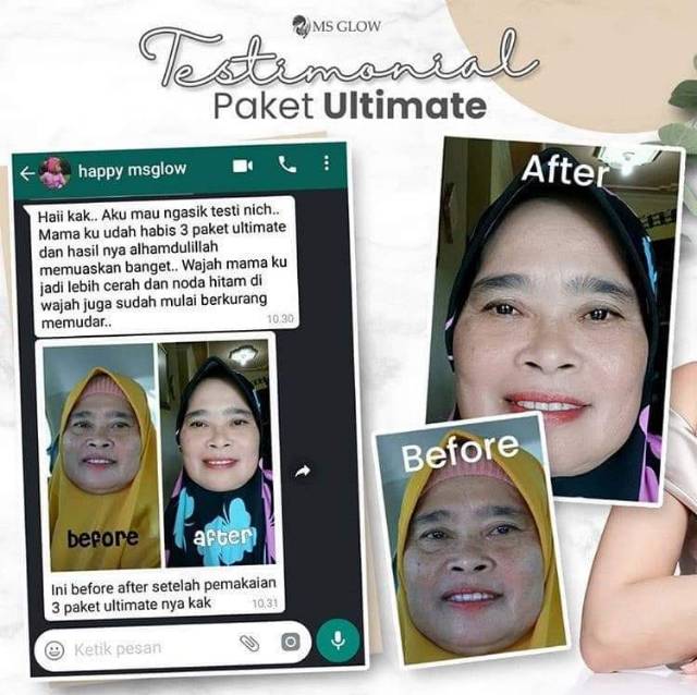 MS GLOW Paket ULtimate (untuk fLek membandeL)