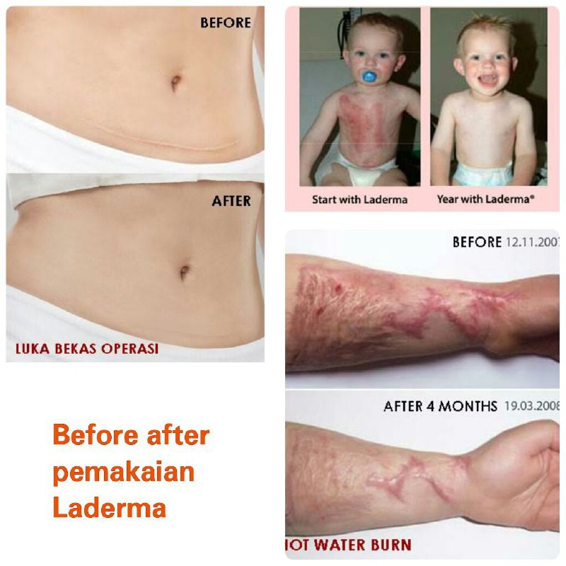 Laderma Scar Repair Cream Penghilang Bekas Luka Jerawat, Caesar, Bakar