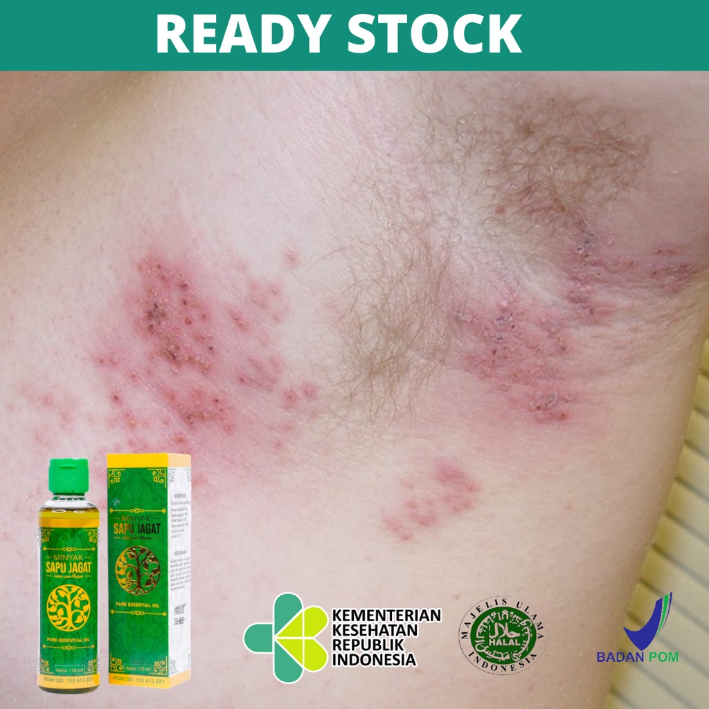 Obat Ketiak Gatal, Gatal Merah Pada Ketiak, Alergi Deodoran, Iritasi Ketiak, Dermatitis Atopik, Ruam