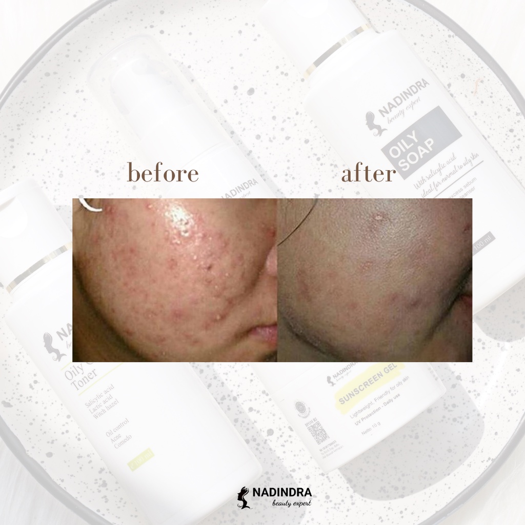 Nadindra Beauty Expert paket Pre Treatment Acne - step 1 / netralisir efek samping skincare keras-6