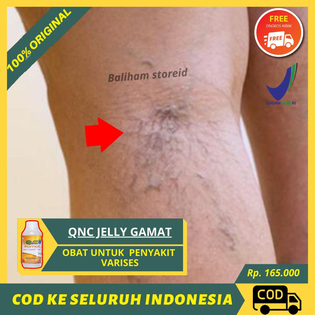 Obat Varises Herbal Di Betis Kaki Vitiligo Kolestrol Bengkak Ampuh Alami Qnc Jelly Gamat Original Shopee Indonesia