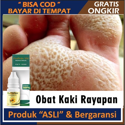 Obat Tetes Kaki Rayapan, Kaki Bolong Bolong Bau, Salep Kaki Rayapan, Cantengan Kaki, Penghilang Kutu