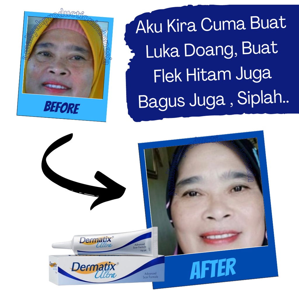 Penghilang Bekas Luka Hitam Koreng Di Kaki Yang Sudah Menahun Salep Cream Strechmark Bumil Dan Busui Obat Selulit Penghilang Bekas Luka Operasi Cesar Ampuh Bpom Dermatix Ultra Gel 15gr Original