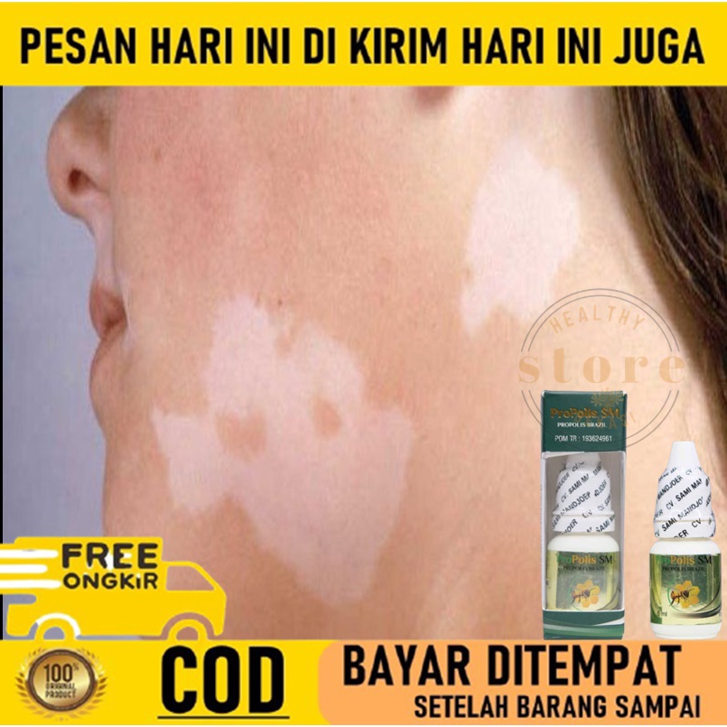 Obat Oles Panu - Obat Panu di Wajah - Obat Panu Kadas Kudis Kurap - Obat Panu anak - Obat Panu Gatal