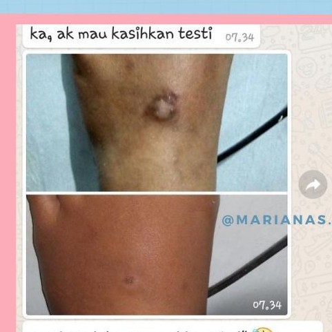 Cream Penghilang Keloid Tidak Rata Karna Menebal Shopee Indonesia