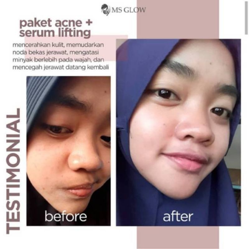 Paket Acne MS Glow Paket wajah 100% original perawatan wajah menghilangkan jerawat(bisa cod)