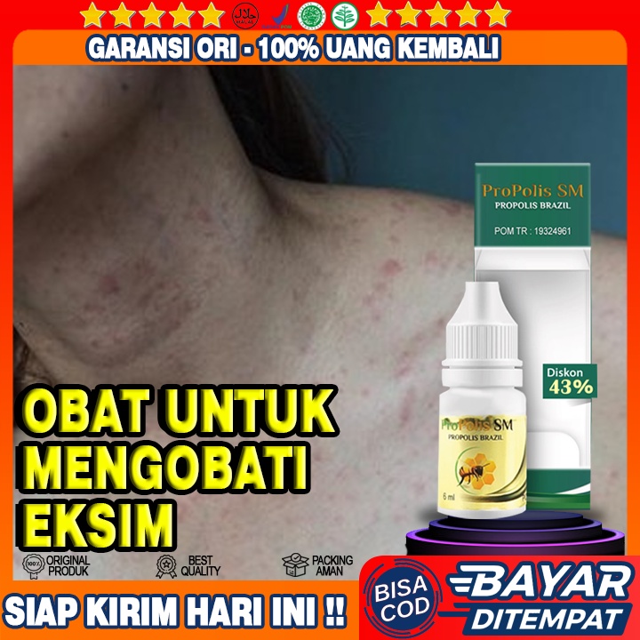 Obat Eksim Berkhasiat, Obat Eksim Kering Menahun, Obat Eksim Gatal