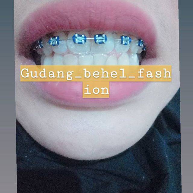 Pasang Behel Kota Padang Cuma 150 000 Indonesia